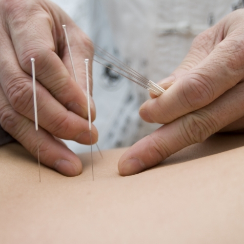 dry-needling-Optimum-Healh-and-Wellness-Ketchikan-AK