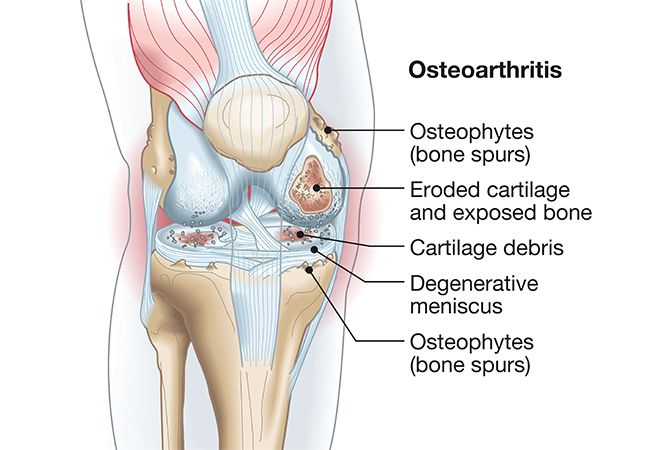Find Relief from Osteoarthritis Pain